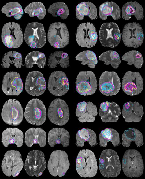 Pdf The Multimodal Brain Tumor Image Segmentation Benchmark Brats