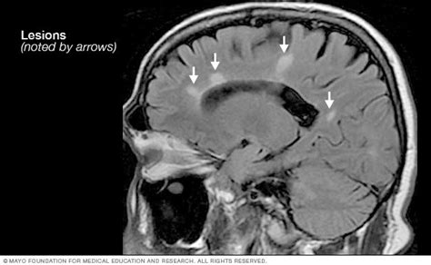 Multiple sclerosis Disease Reference Guide - Drugs.com