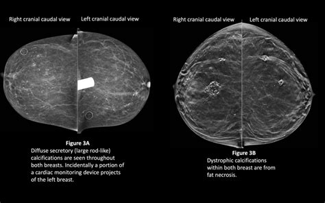 Figure Secretory And Dystrophic Calcifications Contributed By Brooke