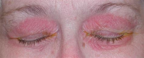 Contact Dermatitis Eyelids