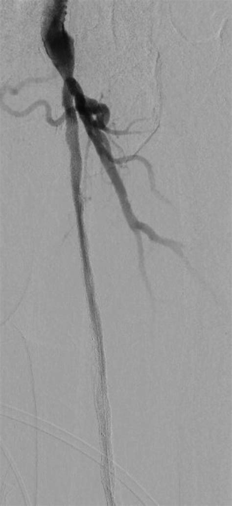 Proximal extent of the stented superficial femoral artery (SFA) with ...