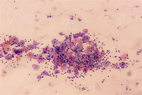 Microscopic View Of Paps Smear Showing Severe Negative For