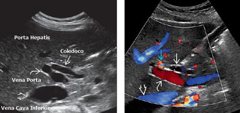 Ultrasonido De La Ves Cula Y El Rbol Biliar Gastro M Rida