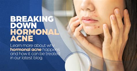 The Breakout Battle Understanding Hormonal Acne Alamo Heights Dermatology