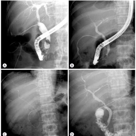 Cholangiogram Of An Anastomotic Stricture As In A Year Old Man