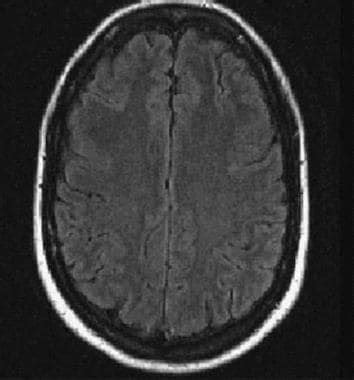 Capillary Telangiectasia Brain Imaging Practice Essentials Magnetic