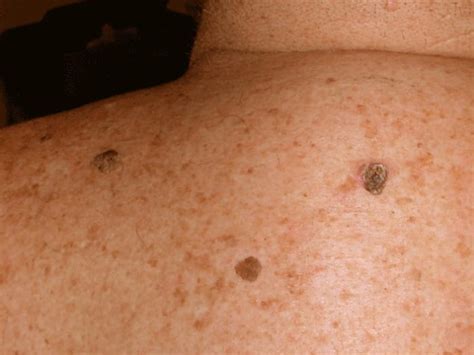 How To Describe Seborrheic Keratosis Using Dermatological Terms