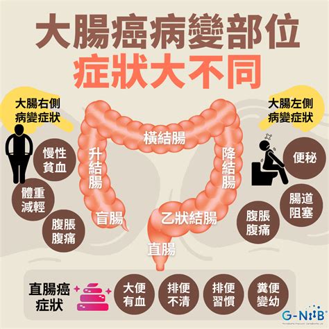 大腸癌病變部位 症狀大不同 Geniebiome Limited 用科研重建健康微生態