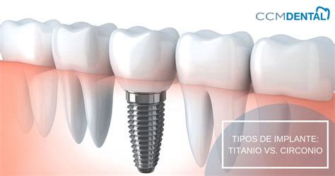 Dos Tipos De Implantes Dentales Titanio Vs Circonio Ccm Dental