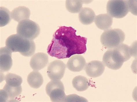 Circulating abnormal promyelocyte