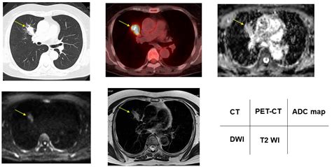 Cancers Free Full Text Pulmonary Nodule And Mass Superiority Of