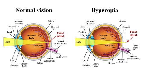 Farsightedness, Causes, Symptoms, Diagnosis, Treatment - Rxharun