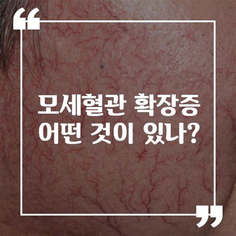 모세혈관 확장증 어떤 것이 있나요 네이버 블로그