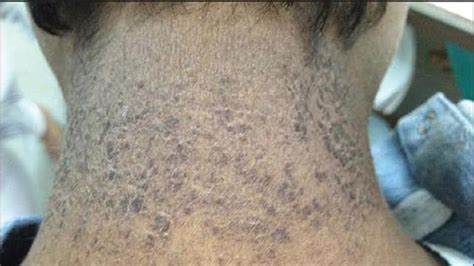 Dermatitis neglecta: Causes, pictures, and treatment