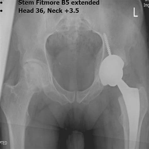 Sample Templated Using Medicad® Software Anteroposterior Right And Download Scientific