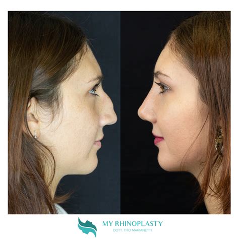 Rinoplastica Roma Vantaggi Dellintervento Al Naso My Rhinoplasty