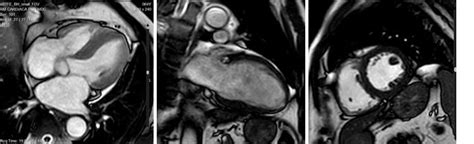 Risonanza Magnetica Cardiaca Aperta Convenzionata A Roma