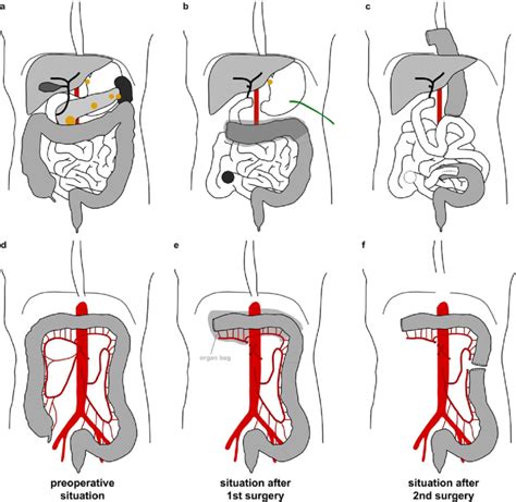 Schematic Drawing Of Anatomical Situations A C Gastrointestinal Download Scientific Diagram