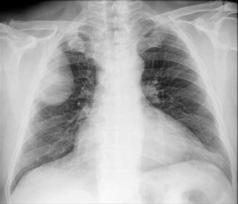 Pleural Liposarcoma Eurorad