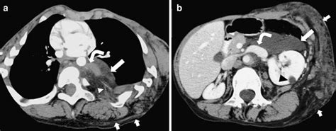 Imaging Findings In Cloves Syndrome Enhanced Ct Scan Of The Chest A