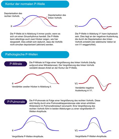 EKG Interpretation Merkmale Des Normalen EKGs P Welle QRS Komplex