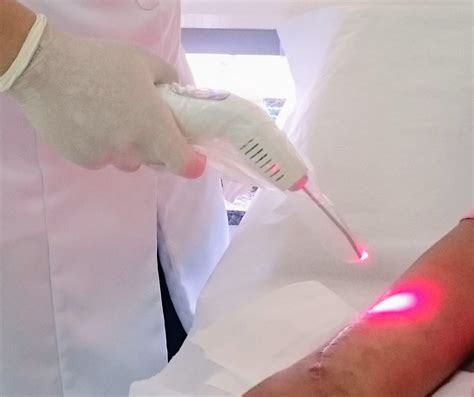 Conhe A Os Benef Cios Da Laserterapia No Tratamento De Feridas Leviva