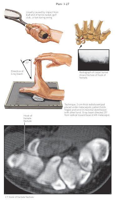 FRACTURE OF HAMULUS OF HAMATE Fractures of the hamulus (hook) of the ...