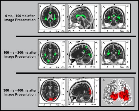 Source Localized Sloreta Eeg Activation Differences Differences For