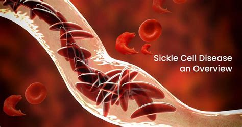 Sickle Cell Disease An Overview