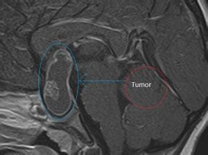 Case Study Series Craniopharyngioma Neurosurgeons Located In Long