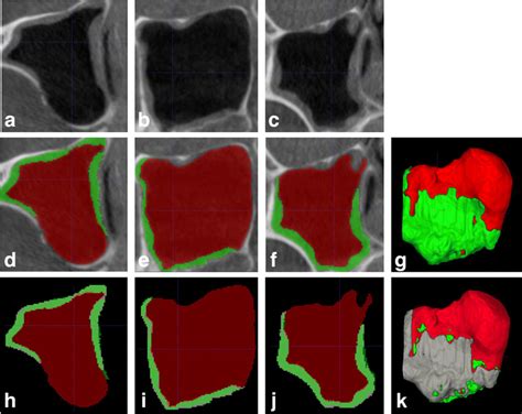 Representative Cbct Images Illustrating Manual And Automatic