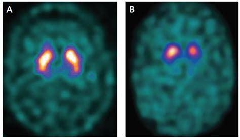 Imaging in Parkinson’s Disease - Practical Neurology