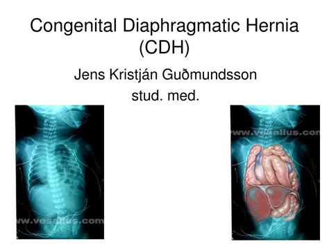 Ppt Congenital Diaphragmatic Hernia Cdh Powerpoint Presentation