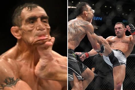 Tony Ferguson Left Almost Unrecognisable With Face Disfigured From