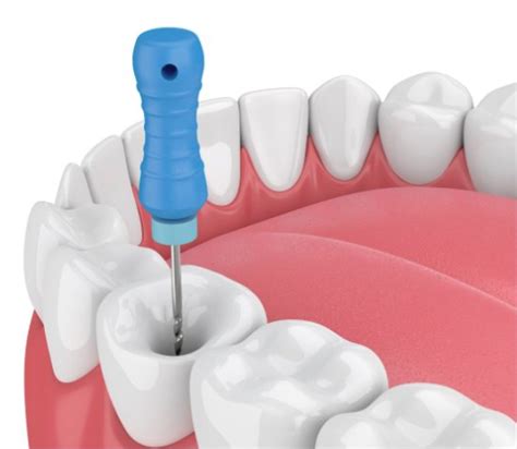 Understanding A Root Canal Procedure