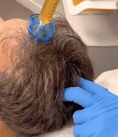 Prp For Hair Loss Boston Applied Biologics