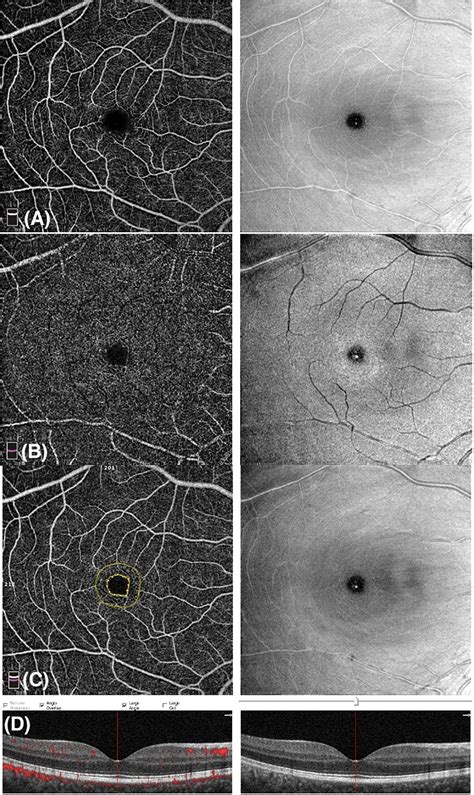 Frontiers Retinal Vascular Assessment In Psoriasis A Multicenter Study