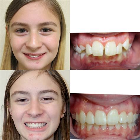 Braces Before And After Overjet