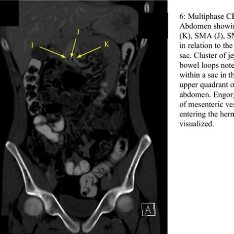 Multiphasic Cect Abdomen And Pelvis Showing Left Sided Paraduodenal Hernia Download Scientific