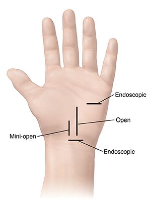 Carpal Tunnel Release Surgery Spectrum Health Lakeland