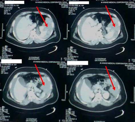 Figure 1 From Ruptured Spleen In Factor Xiii Deficiency Semantic Scholar