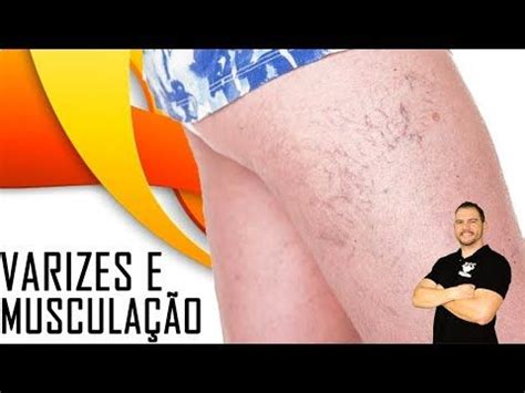 Quem Tem Varizes Pode Fazer Atividade Física Musculação Canal do