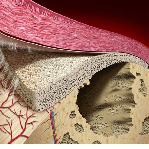 Vertical Bone Augmentation By Guided Bone Regeneration Gbr In The