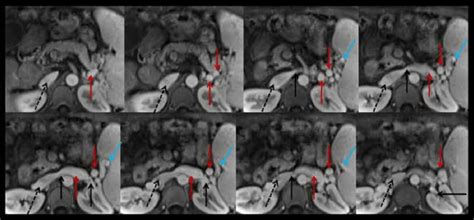 Axial Contrast Enhanced Mri Scans At The Portal Vein Phase In A Download Scientific Diagram