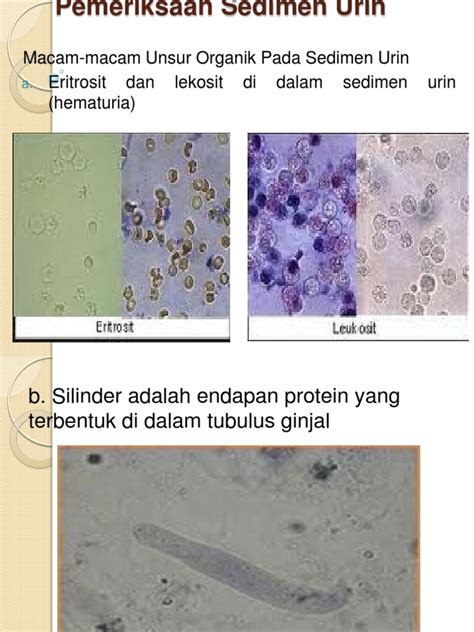 Pemeriksaan Sedimen Urin