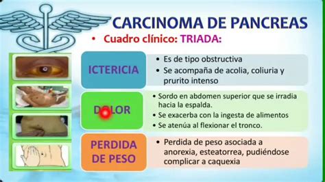 Descubre el inicio del cáncer de páncreas causas y síntomas