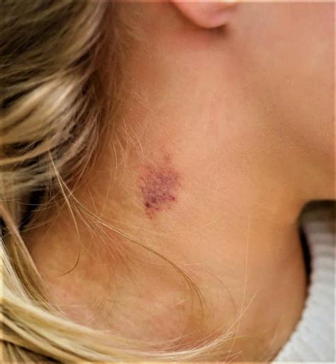 Hickey Vs Bruise Telegraph