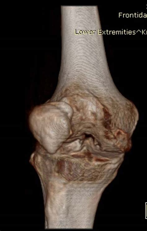 ACUTE PATELLAR DISLOCATION | GEORGE D. GOUDELIS MD. Ph.D.