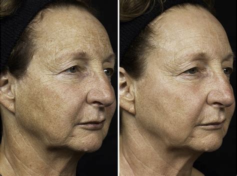 Before And After Radiance Skincare And Laser Medspa Wheaton Il