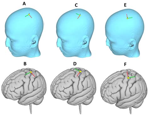 Transcranial Magnetic Stimulation Tms Coil Orientations Examined The